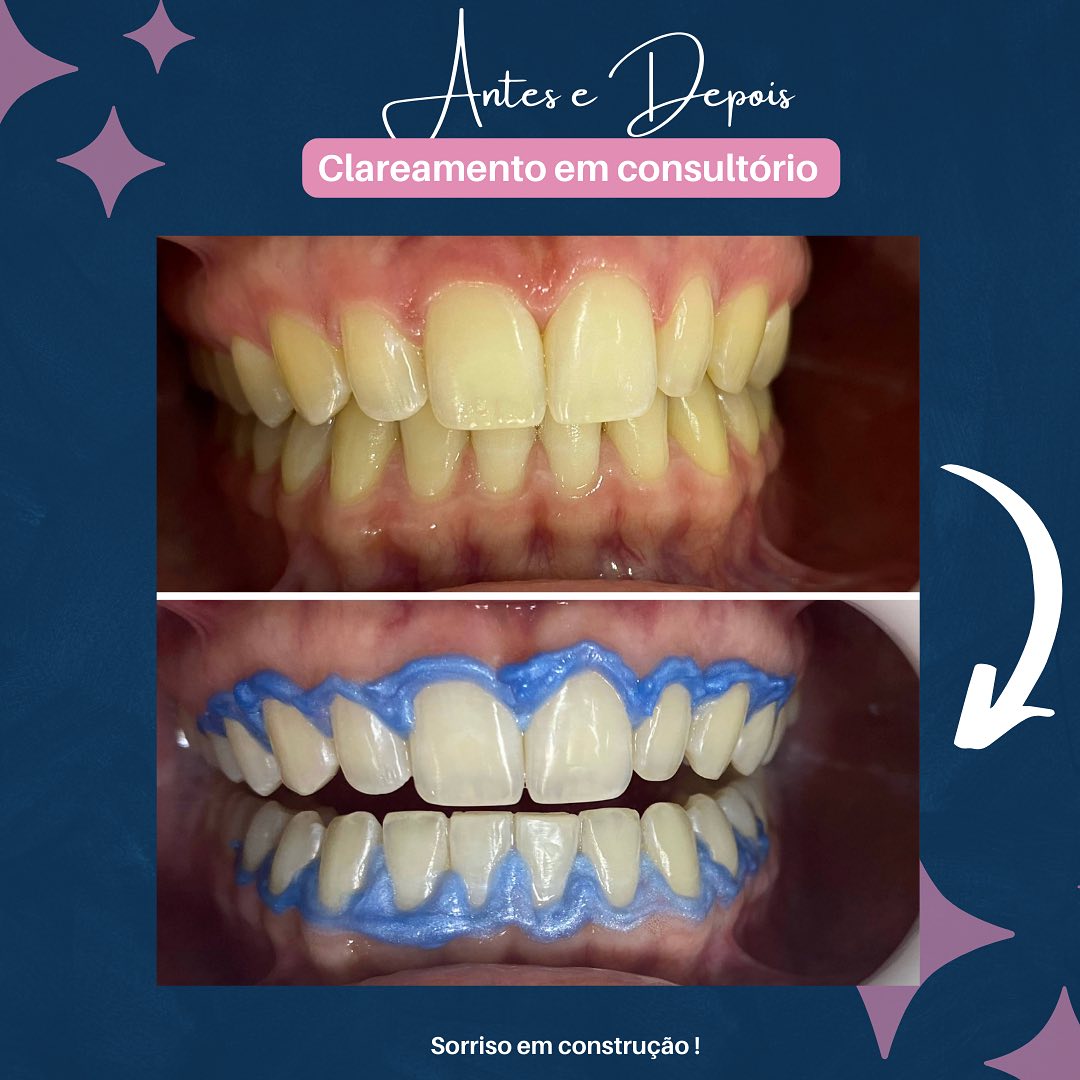 Resultado 1: Descrição do procedimento e foto antes/depois